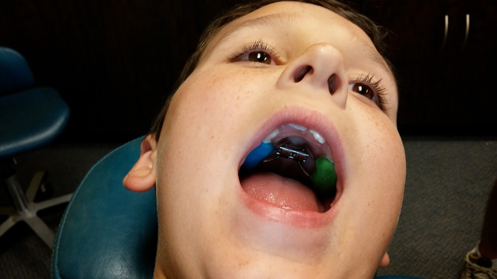 expanders palatal dentist